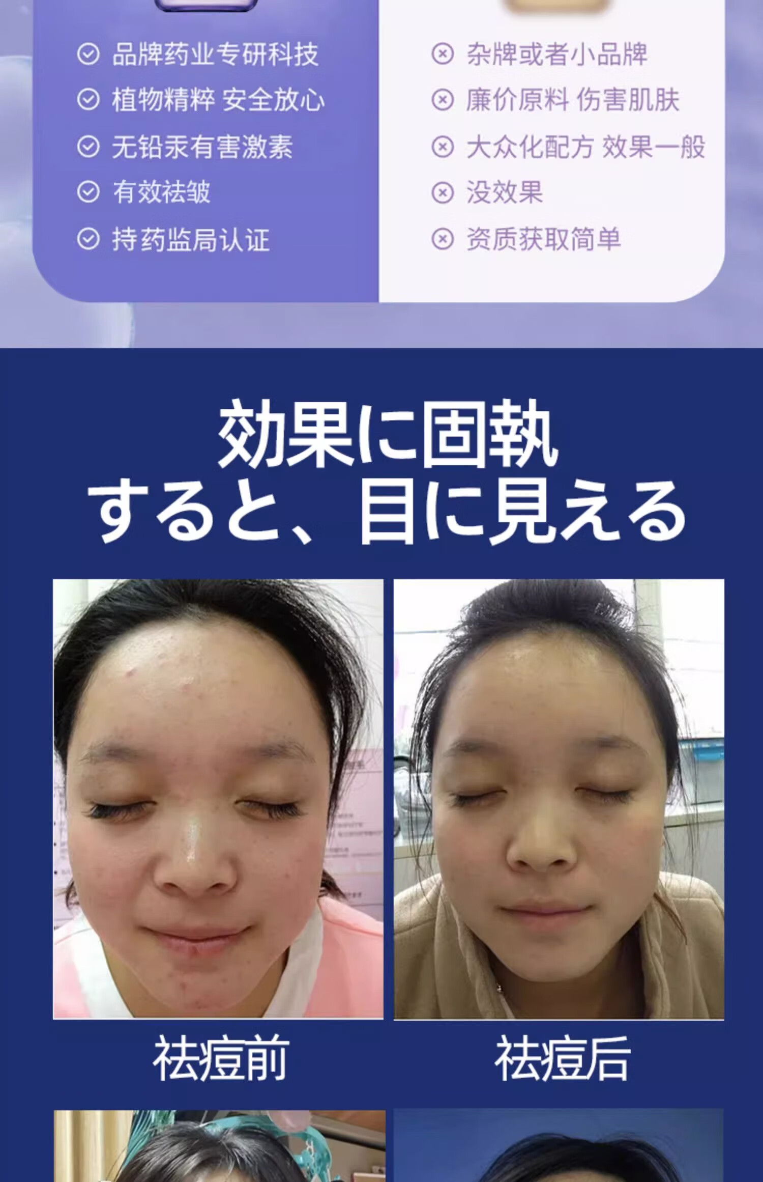 NHFOUYOU祛痘精华液祛痘膏去闭口粉刺痘坑痘印淡化消印收缩毛孔精华液 一瓶【30ml】建议按疗程使用