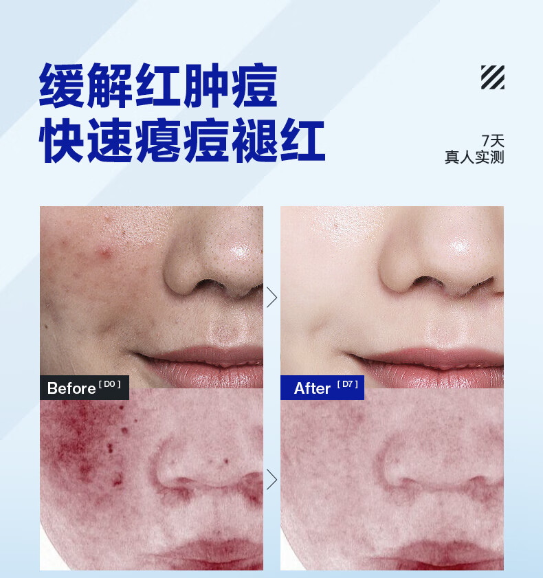 海洋至尊清肌祛痘膏淡化痘印青春豆豆收缩毛孔闭口粉刺凝胶男士 单瓶装20g
