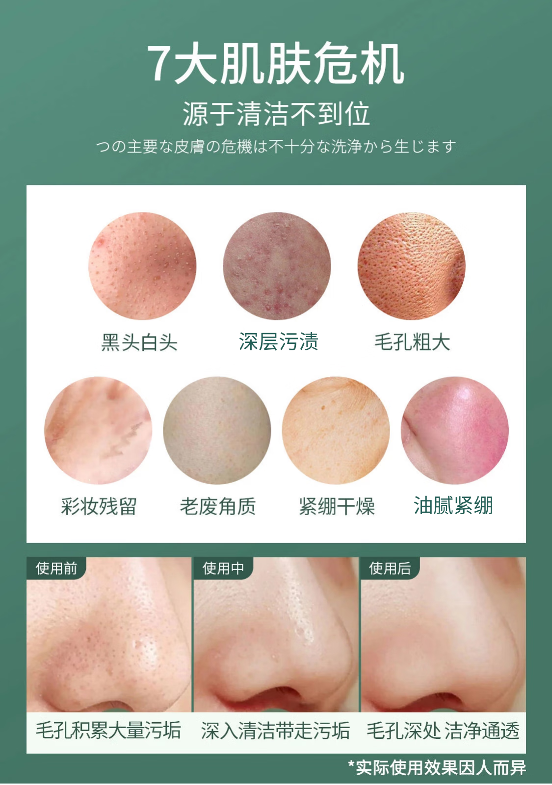 MDB 多酸去黑头小气泡清洁泡泡面膜积雪草水杨酸自发泡收敛毛孔男女 200g【2只优惠装】
