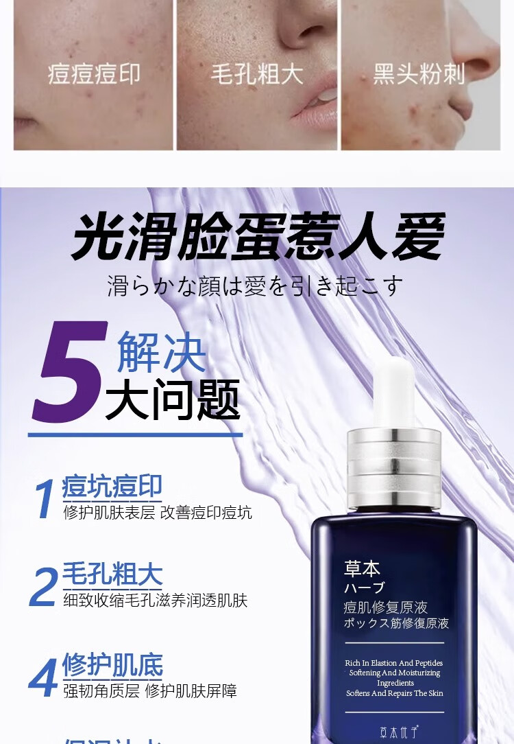 NHFOUYOU祛痘精华液祛痘膏去闭口粉刺痘坑痘印淡化消印收缩毛孔精华液 一瓶【30ml】建议按疗程使用