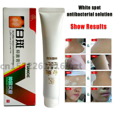 Chinese Medical White Spot Disease Cream Pigment Melanin Promoting Liniment Skin Vitiligo Leukoplakia Disease Treatment 30g
Chinese Medical White Spot Disease Cream Pigment Melanin Promoting Liniment Skin Vitiligo Leukoplakia Disease Treatment 30g