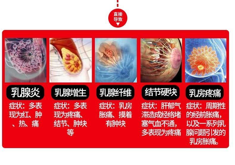 药房同款乳腺贴乳腺增生贴结节硬块乳腺囊肿小叶增生多发低回声结节