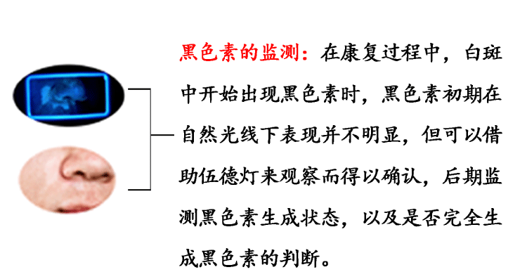 伍德氏灯白癜风检测仪皮肤真菌白斑宠物猫藓家用wood灯荧光剂 款伍德