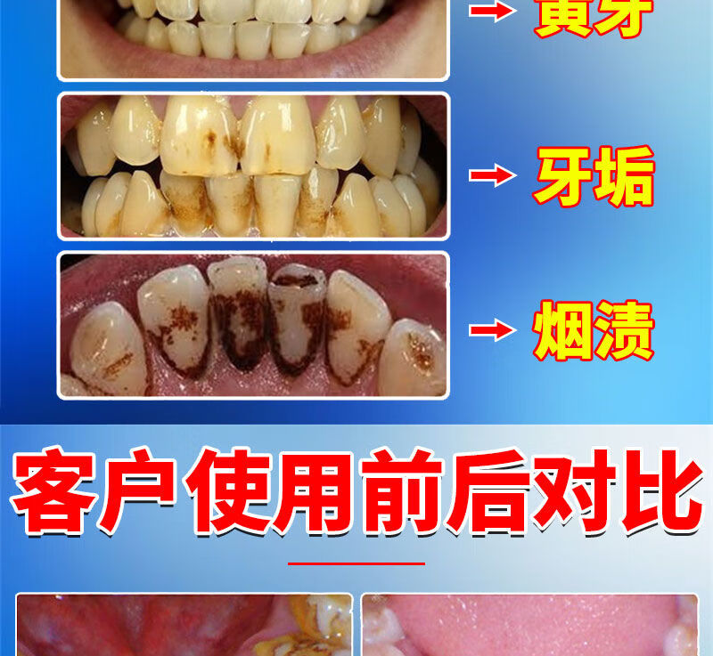 【牙齿结石喷剂】牙结石牙垢口i臭烟渍牙渍牙斑牙齿美