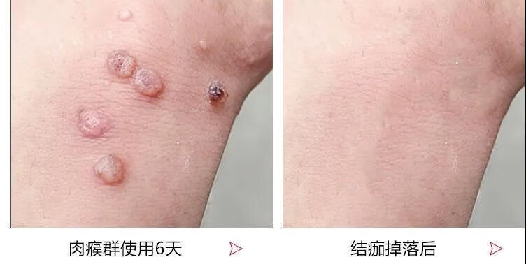 其它身体护理 梦希蓝(mengxilan) 去除脖子小肉粒丝状小肉粒小猴子净