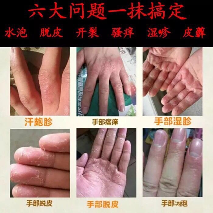 汗泡疹膏手脱皮季节性手上起小水泡汗i孢疹手气型手痒干裂反复