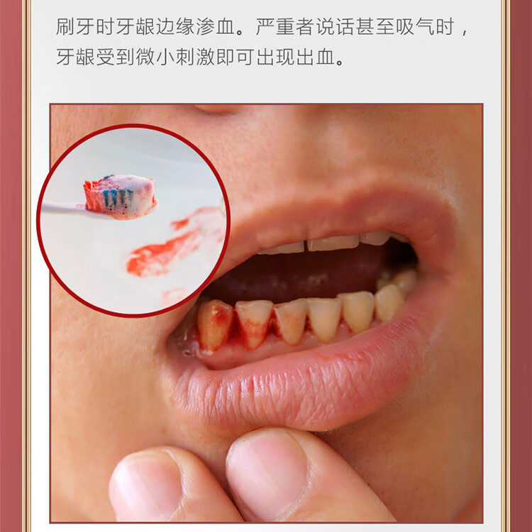 牙龈萎缩修复牙龈松动专用牙膏牙齿敏感牙龈出血牙可舒冷敷凝胶金力康