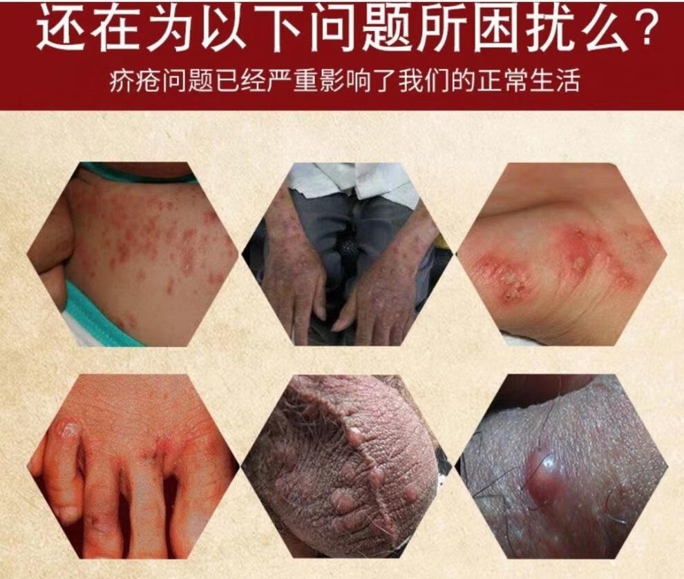 驼峰疥i疮膏硫磺软膏疥i疮一扫光快速止痒祛阴囊结节祛虱去螨虫 单买