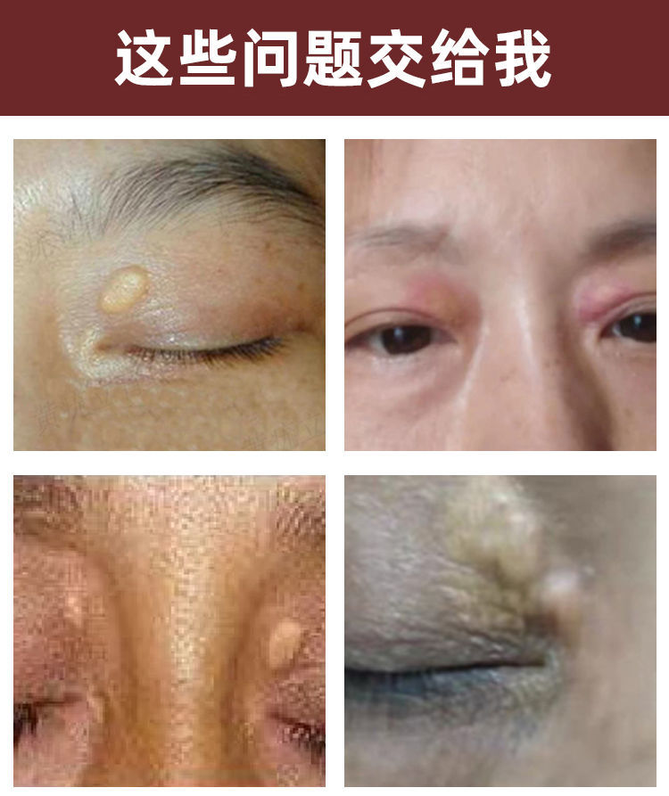 无痛去睑黄瘤去除睑黄疣脸黄瘤眼部眼睑黄瘤脂肪l粒草本睑黄膏买3赠2