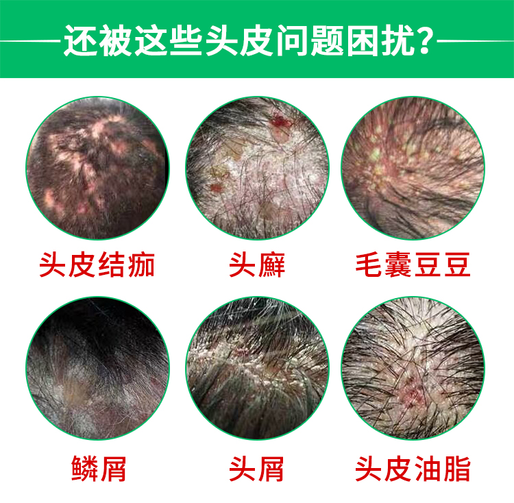 头皮真菌感染脓包痤疮毛囊炎外用软膏止痒头部专用