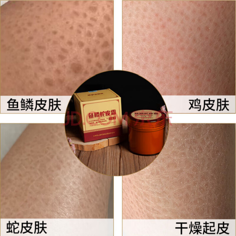 鱼鳞皮肤霜去鱼鳞皮肤蛇皮腿护肤乳滋润保湿霜外用小腿鱼鳞纹路全身