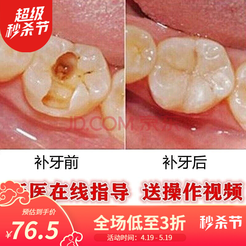牙齿有洞自己动手补牙洞堵牙洞材料虫牙蛀牙龋齿补牙粉填牙洞胶水