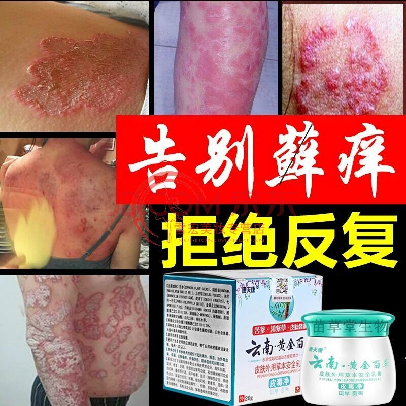 治大腿瘙痒牛皮i藓皮i炎小红点大腿根部烂皮肤顽疾箹膏拍1发3盒疗程装