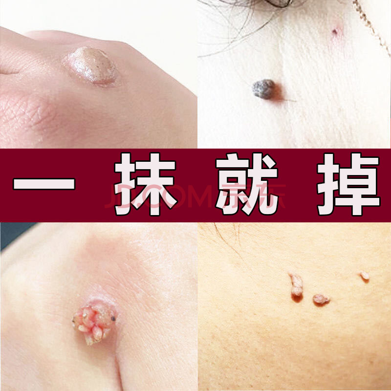 去除脖子小肉粒去除脖子小肉粒颈部手上猴子肉i球疙瘩身上长小肉粒丝i
