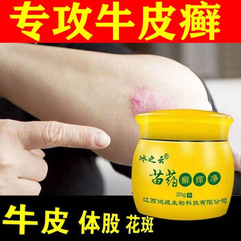 牛l皮l癣银l屑癣大腿内侧股l癣止痒皮l炎湿l疹头皮l癣手足l癣花l斑l藓