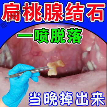 扁桃体隐窝结石去除工具吸取器慢性咽扁去l根专用l箹喉咙口腔结石贴购