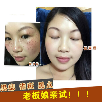 伊始美容金水去痣点痣水无痕点斑水雀斑黑痣祛痣点志膏取痣
