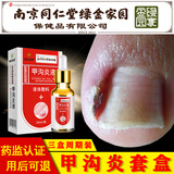 【无需拔甲】甲沟炎专用药监备案软膏液能搭配嵌甲后消肿治疗正甲矫正
