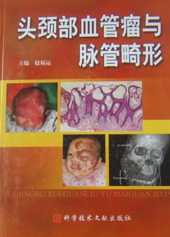 头颈部血管瘤与脉管畸形