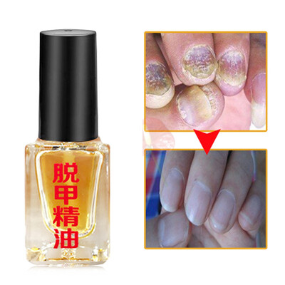 

Nail Treatment Removal Onychomycosis Paronychia Anti Oil Bactericidal Nail Fungal Nail Infection Toe Nail Fungus Treatment