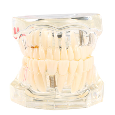 

Transparent Dental Implantation Disease Teeth Model Teaching Teeth Tool Dental Adult Typodont Removable Teeth Model