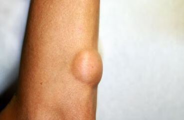 滑膜肉瘤是一种罕见的软组织肉瘤,常见于四肢,尤其是膝关节周围