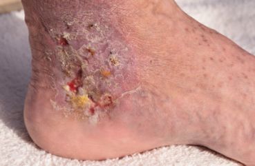 西安交通大学第一附属医院指蜂窝组织炎推荐专家