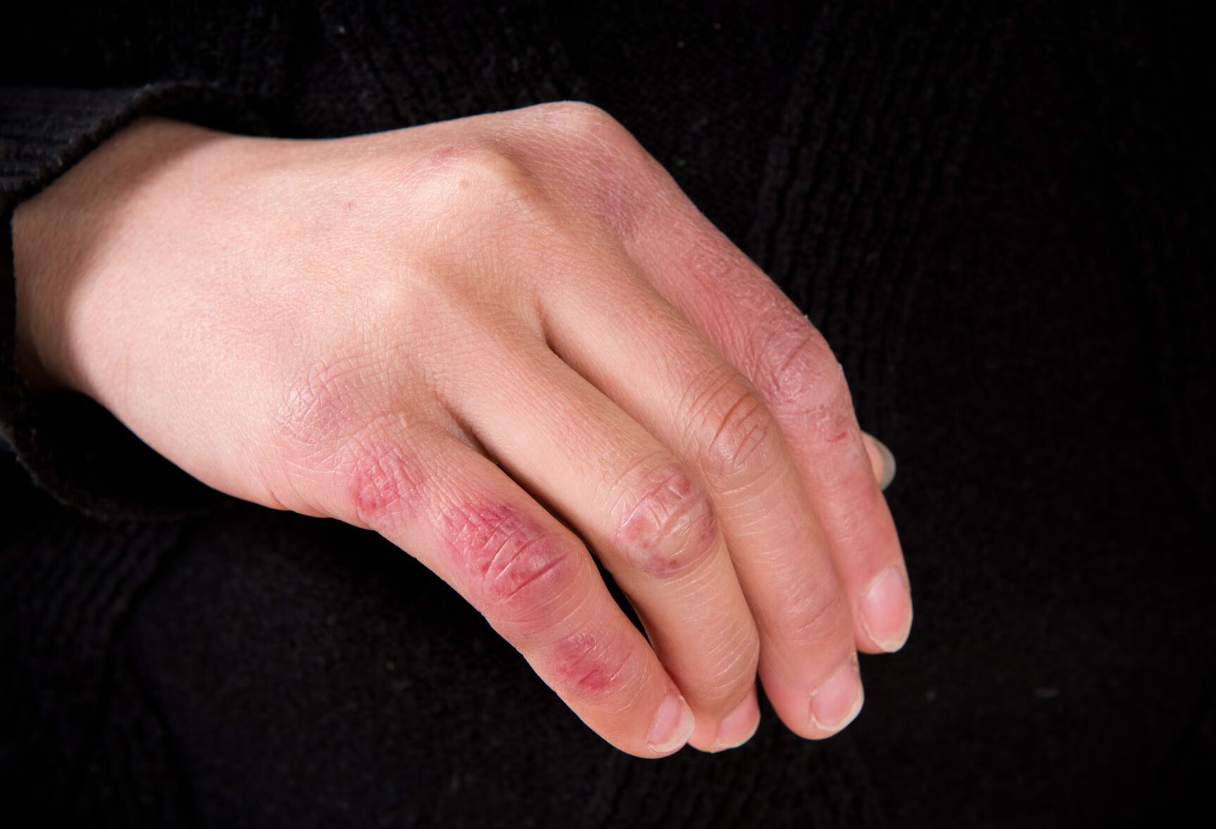 郑州大学第二附属医院手足皲裂推荐专家