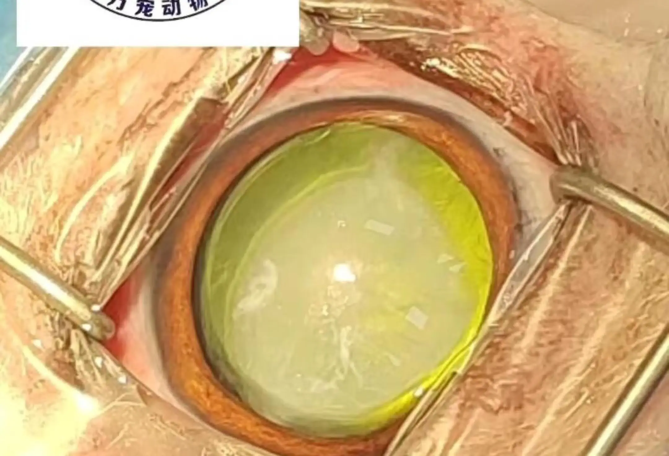 河南省焦作复明眼科医院晶状体脱位专家