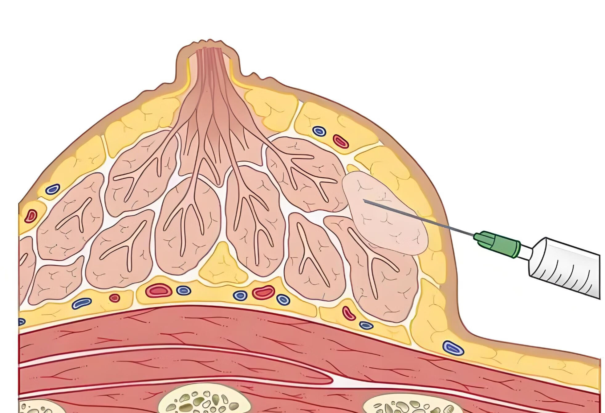 江苏省中医院-乳腺穿刺-专家在线问诊-京东健康互联网医院