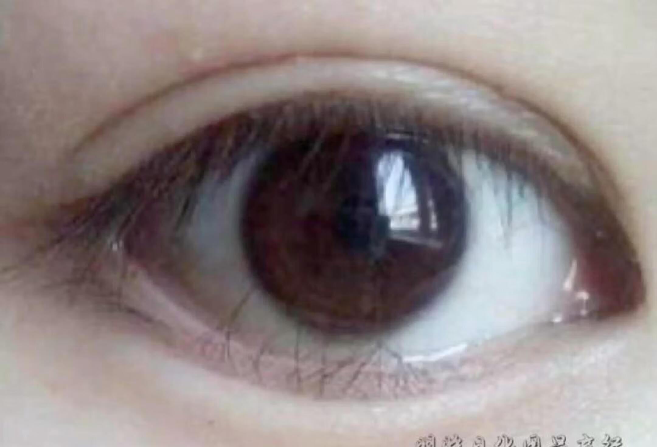 角膜云翳-专家在线问诊-京东健康互联网医院