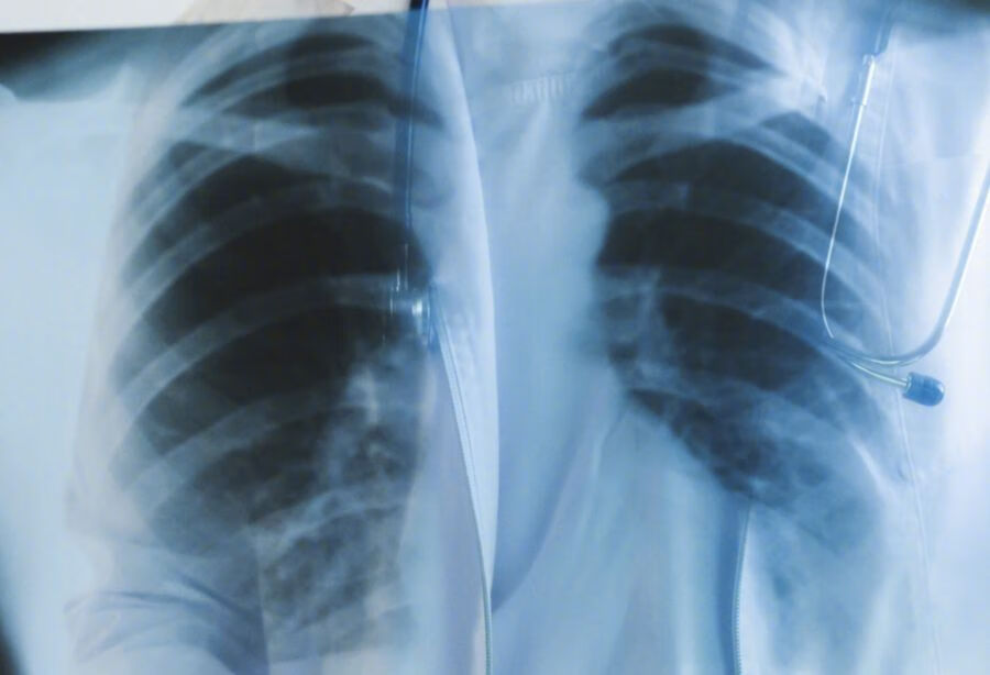 西安交通大学第一附属医院自发性气胸推荐专家