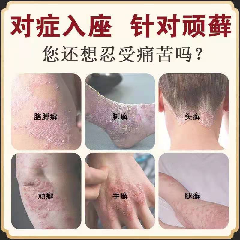 思绪药店直售思铍药师软膏手足癣皮肤瘙痒过敏膏牛皮癣膏一抹灵买213