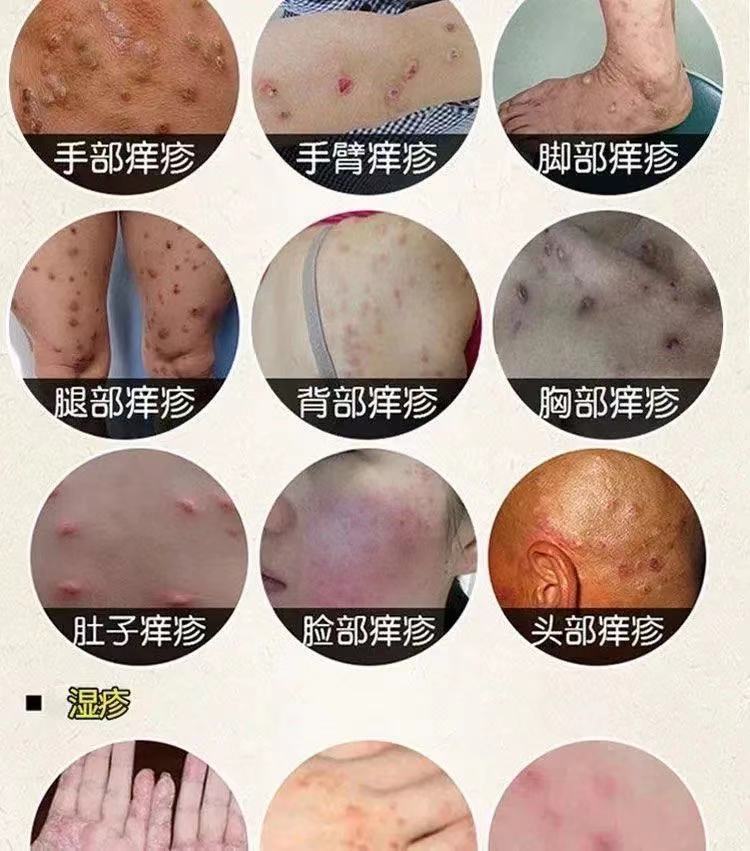 结节性痒i疹膏止痒顽固性慢性结痂性痒i疹结节性皮肤皮l炎瘙痒老偏方1