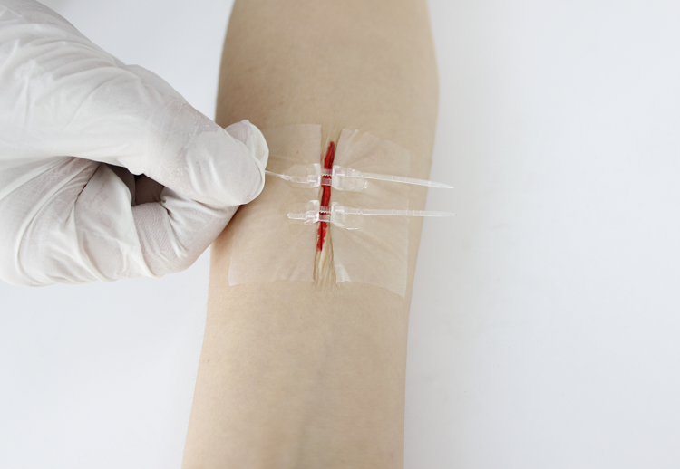 减张贴疤痕增生术后免缝合刀口贴拉链式减张器剖腹产伤口愈合【图片