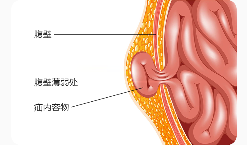 维力健医用腹股沟斜疝气带老人成人男女士中老年小肠