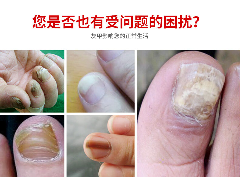 灰甲灵甲沟炎专用灰指甲不包扎不修甲 顽固增厚严重型灰甲烂甲清净提