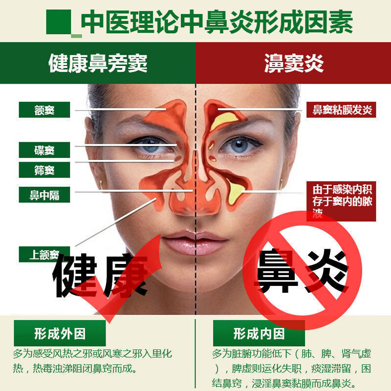鼻炎膏儿童成人慢性鼻窦炎鼻塞流鼻涕打喷嚏过敏性鼻炎神器 发5瓶