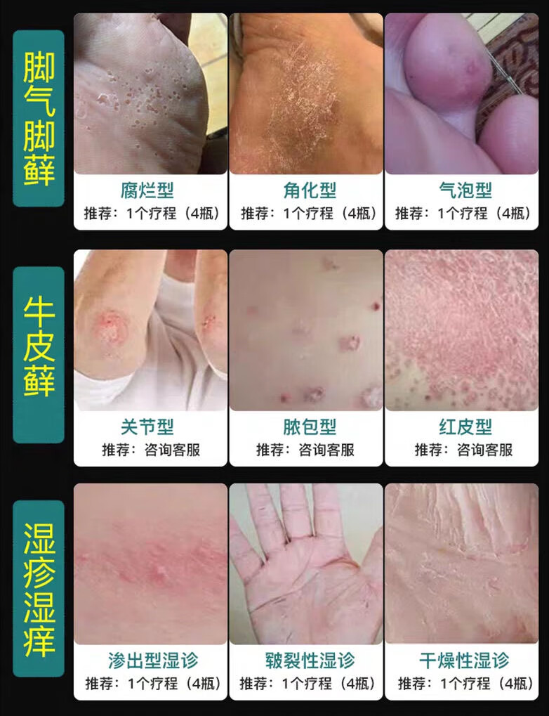 旗舰品质芙贝乐滇南益夫膏神经性皮肤x炎软膏大腿内侧止痒外阴x瘙痒