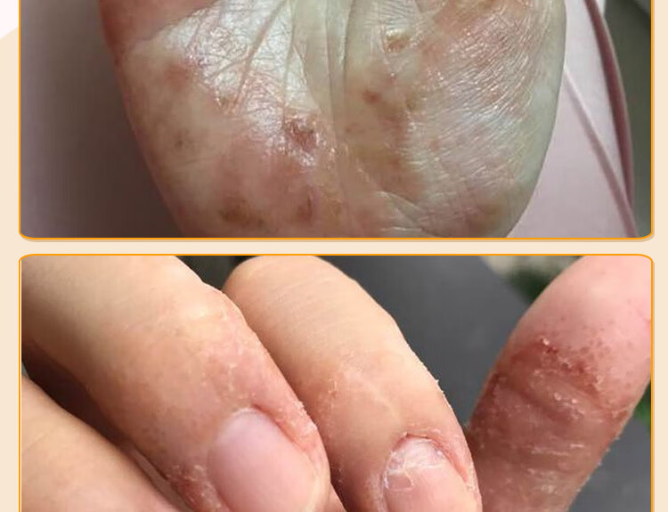 【官方旗舰】京康恩京康恩膏皮ii焱湿诊汗泡ii疹手