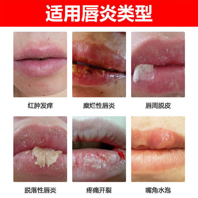 唇ii炎膏润唇膏嘴唇干裂保湿修复唇周炎过敏性口角炎脱皮红肿瘙痒膏3