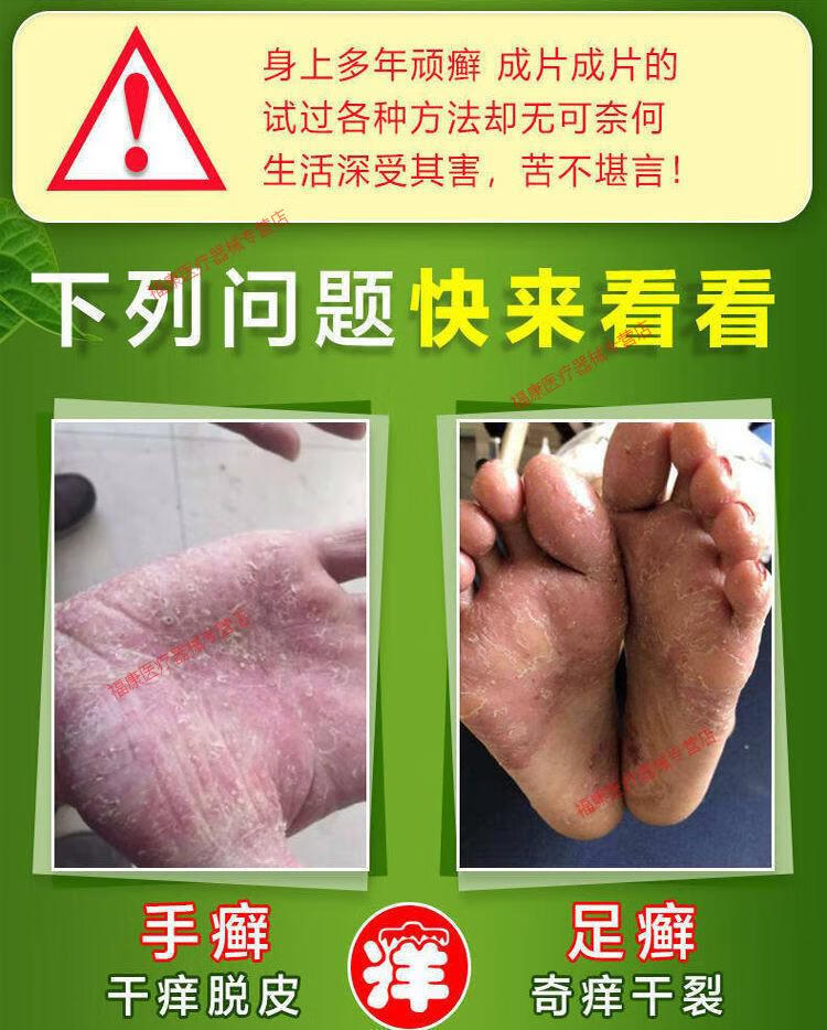 苗家老偏方皮癣牛专用皮肤癣痒灵瘙痒皮炎疹湿癣菌克星癣手足10支祛除