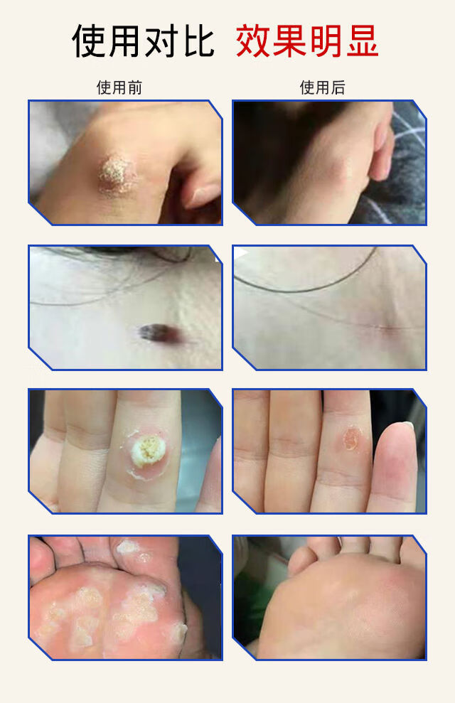 疣瘊肉粒一抹无忧加丹一号去脖子疙瘩扁平丝状尤鸡茧猴子1盒15ml