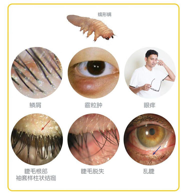 专柜yourga悦家茶树精油洁护眼贴奥科视光缘螨净茶树精油螨湿巾眼部