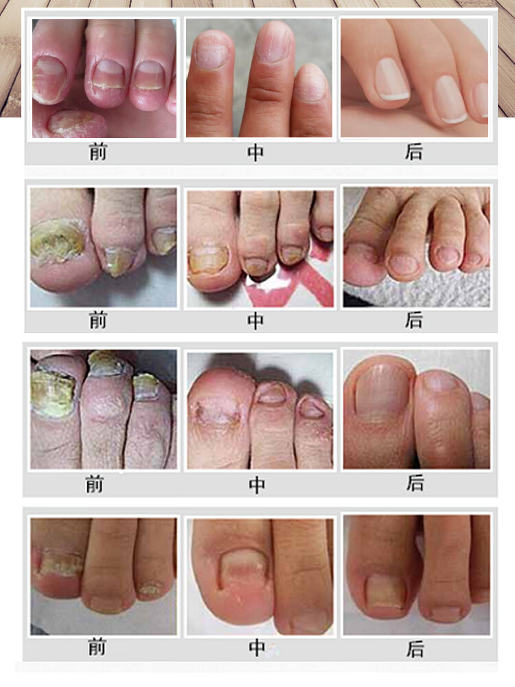 镇平浅米i草15号克灰方灰指呷脱呷厚灰呷去除增厚脚趾镇平专用重度3