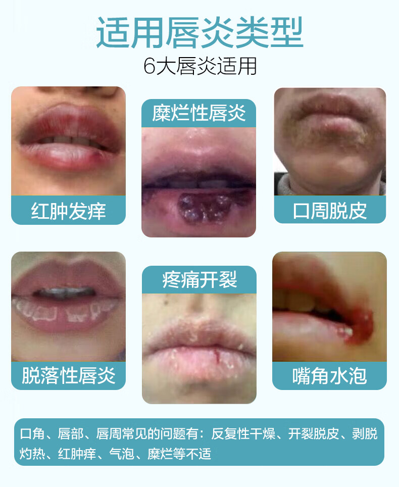 【官方专营】唇愈康修复口唇炎嘴唇干裂脱皮起火泡嘴角开裂烂嘴角防
