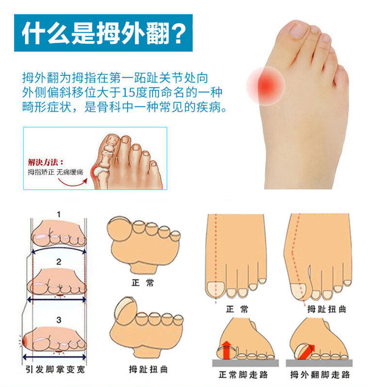 日本脚趾矫正器分趾器分离器可穿鞋大脚趾拇外翻矫正脚趾头纠正器的一