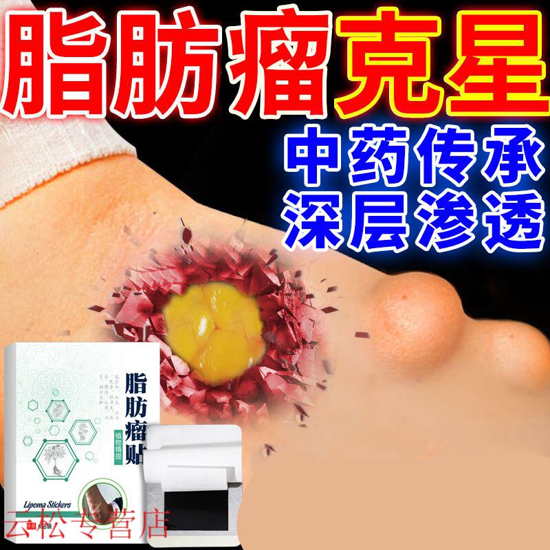 脂肪瘤去除全身皮下脂肪留消贴多发性消瘤膏消除硬块克i星 六贴 北京