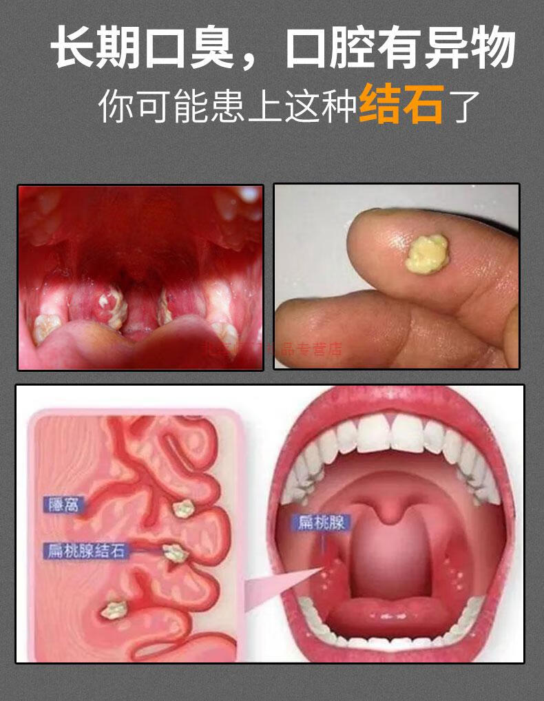 预防扁桃体结石图片