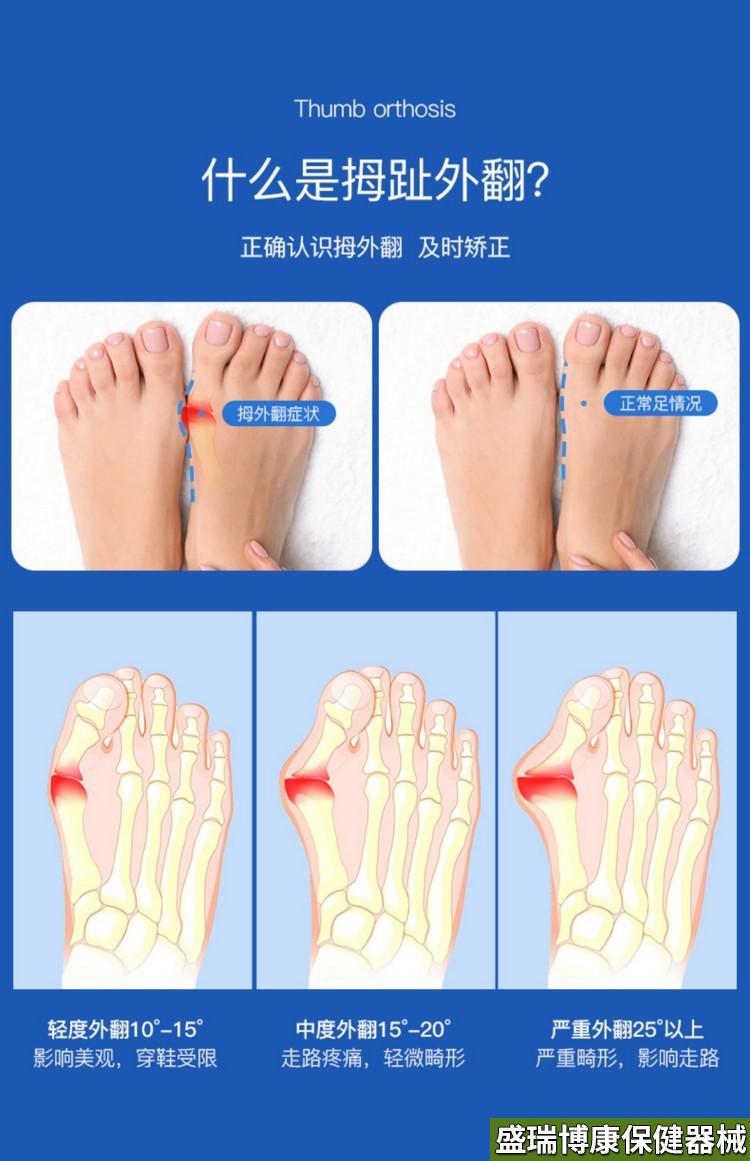 医用健康 脚趾分离器大拇指内翻器大脚趾脚大拇指指甲器分离工具